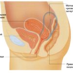 Загиб матки: симптомы, виды, причины и лечение