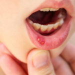 Стоматит у детей — Симптомы, причины и лечение
