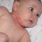 Потница у новорожденных — Симптомы, причины и лечение