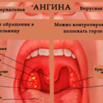 Ангина — Симптомы, причины и лечение