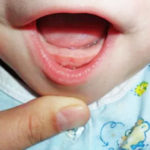 Прорезывание зубов у детей: симптомы